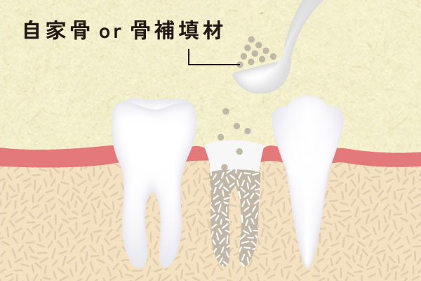 リッジプリザベーション